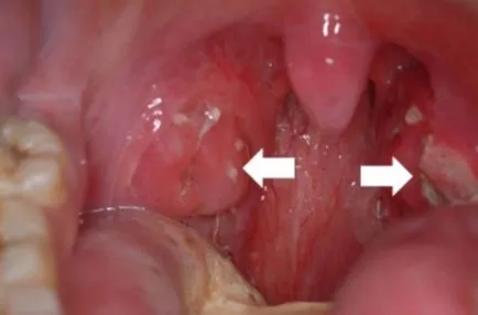 Blistere pe partea din spate a gâtului acest tip de educație roșu și alb, fotografie erupție pe amigdala -