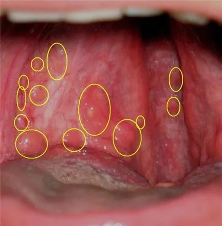 Blistere pe partea din spate a gâtului acest tip de educație roșu și alb, fotografie erupție pe amigdala -