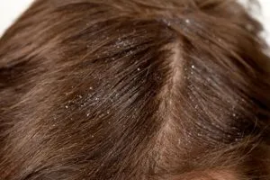 Hair kilábalás kopaszság, hogy ez reális feladat, és hogyan kell megbirkózni vele