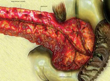 Inflamarea pancreasului - pancreatita si provoaca boli cronice, atunci când și de ce