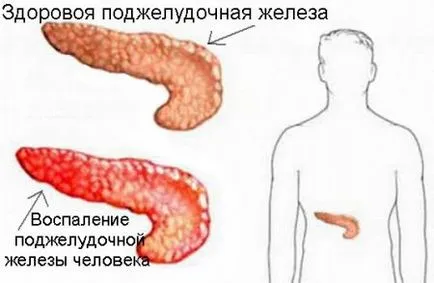 Inflamarea pancreasului - pancreatita si provoaca boli cronice, atunci când și de ce