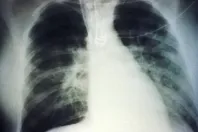 Krónikus nem specifikus tüdőbetegségek Izrael