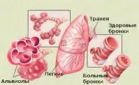 Хронични неспецифични белодробни заболявания в Израел