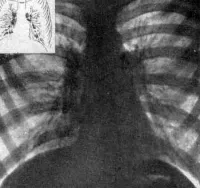 boli pulmonare cronice nespecifice din Israel