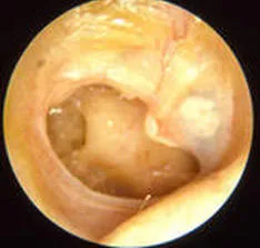 purulente cauze Otita medie cronica, simptome, diagnostic