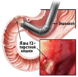 Tratamentul ulcerului duodenal