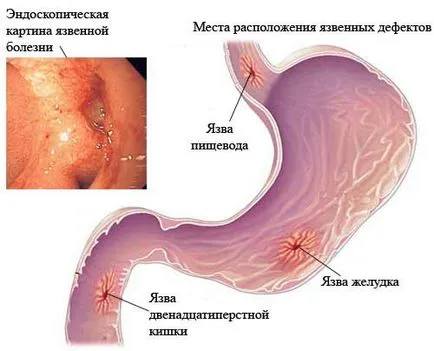 Езофагеална язва симптоми и лечение, диета