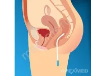 sonda rectala, vapori de tub rectal