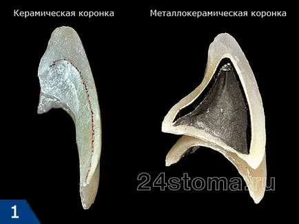 prețurile din porțelan și zirconiu coroane, comentarii, stomatologie