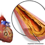 Atherosclerosis a szívkoszorúerek okoz, diagnózis, szövődmények