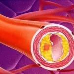 Atherosclerosis a szívkoszorúerek okoz, diagnózis, szövődmények