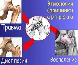 Készülék kezelésére osteoarthritis (osteoarthritis)