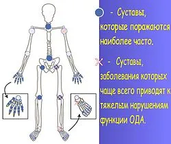 Aparate pentru tratamentul osteoartritei (osteoartrita)