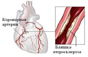 Коронарни симптоми и лечение атеросклероза