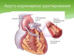 Коронарни симптоми и лечение атеросклероза