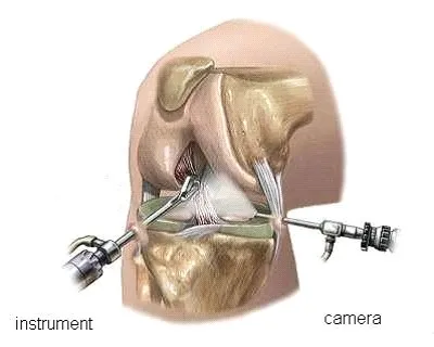 Артроскопия на менискуса на коляното в Москва, направете артроскопска хирургия на менискуса
