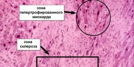 Коронарни симптоми и лечение атеросклероза