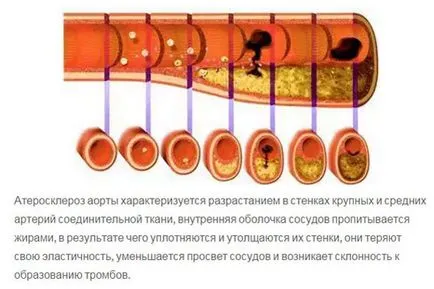 Ateroscleroza a aortei inimii (boala aterosclerotica a aortei toracice) - Cauze, simptome,