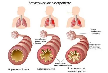 Asztma - nem egy mondat az alapelveket a bronchiális asztma kezelésére