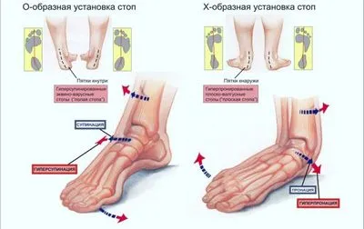 Възпалено на клавиатурата за крака при лечението на пръстите на краката