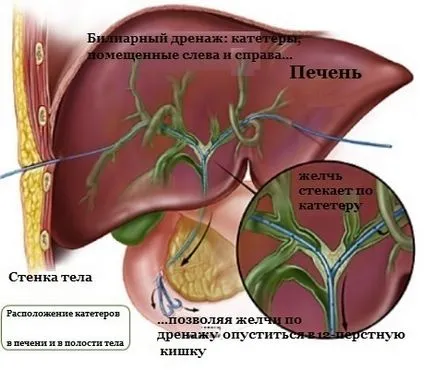 Болест (синдром) Кароли при деца води, диагностика и лечение