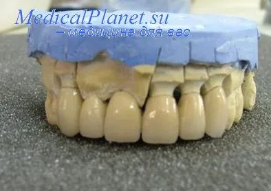 punte dentara All-ceramice