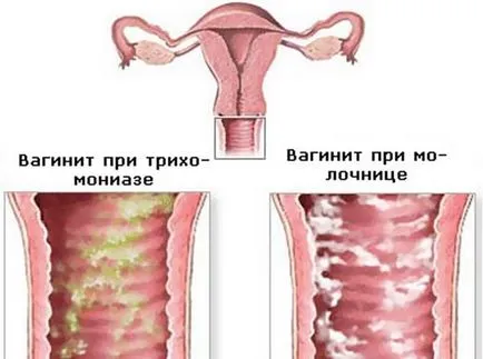 Mennyire veszélyes trichomoniasis szövődmények egészségügyi hatásai