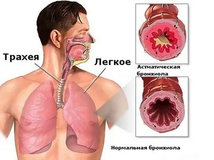 Hörgő asztma kezelésére népi jogorvoslati