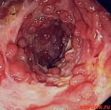 Dixion-egészségügyi - örökletes adenomás polyposis