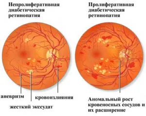 Диабетна ретинопатия какво е, причини и лечение на стъпка