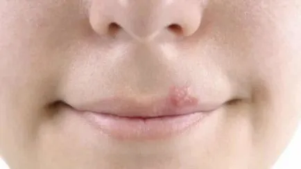 Dermatite, herpes simptome și tratament