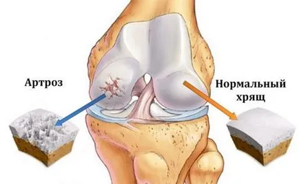 Diet arthrosis