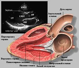 kg Echo infarct miocardic - tratament de inima