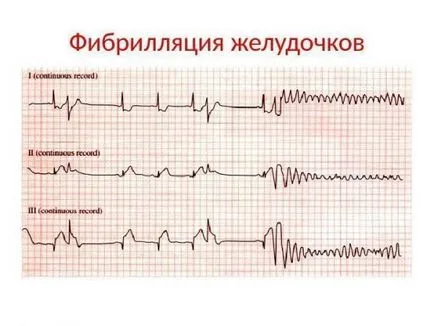 Kamrafibrilláció tünetek, diagnózis, kezelés