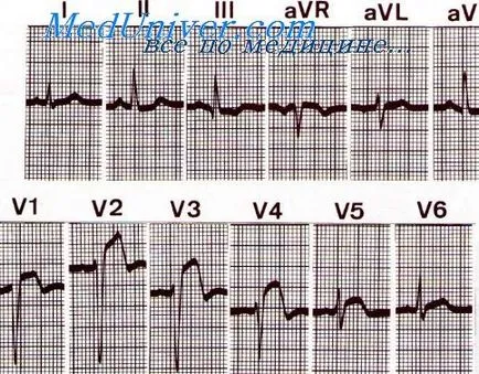 kg Echo infarct miocardic - tratament de inima