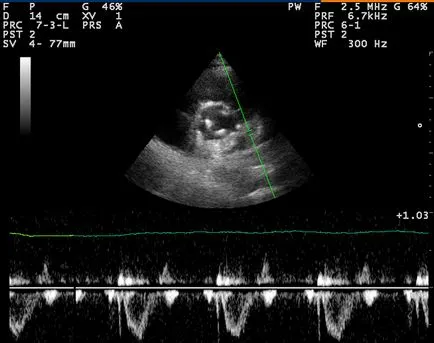 kg Echo infarct miocardic - tratament de inima