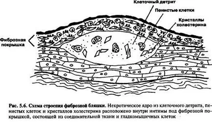 Влакнестият плака