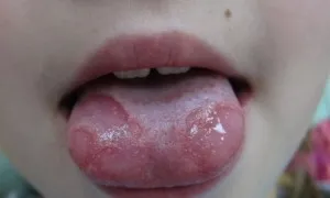 simptome glosita cu fotografii, limba fisurată și tratamentul inflamației la adulți