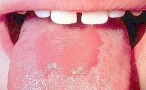 Глосит симптоми със снимки, нацепена език и лечение на възпаление при възрастни