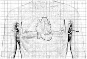 A bal kamrai hipertrófia az EKG-