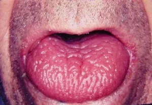 simptome glosita cu fotografii, limba fisurată și tratamentul inflamației la adulți