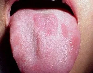 Глосит симптоми със снимки, нацепена език и лечение на възпаление при възрастни