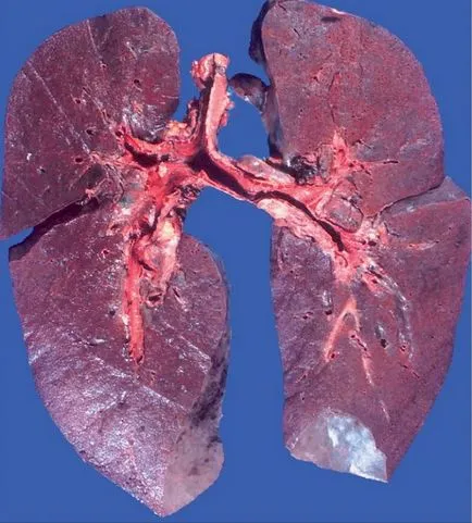 hemosideroza pulmonară