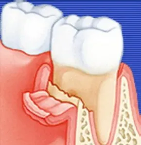 granuláló periodontitis