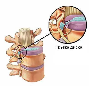 Херния disk- лечение без операция! За да се направи среща в Нижни Новгород,