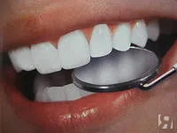 Implanturi dentare, comentarii rău, contraindicații și posibilele consecințe