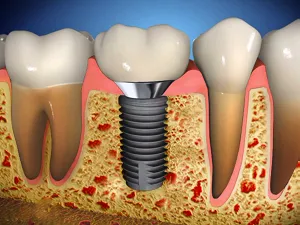 Зъбните импланти ревюта, вреда, противопоказания и възможни последици