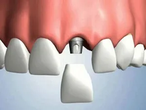 Implanturi dentare, comentarii rău, contraindicații și posibilele consecințe