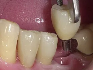 Зъбните импланти ревюта, вреда, противопоказания и възможни последици