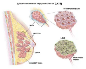 Invazive, lobular, carcinomul mucinos și de sân ductal